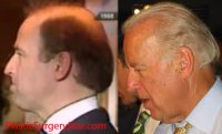 joe-biden-hair-transplant-1.jpg