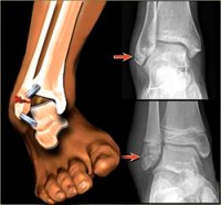 ankle-fracture-treatment.jpg