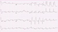 Electrocardiogram ECG-EKG graph.jpg