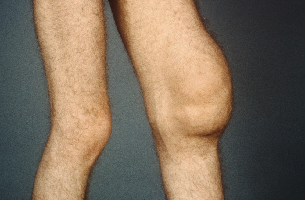 swollenkneess7w2914_1300087.jpg